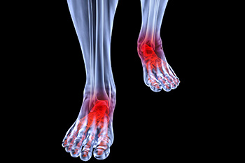 arthritic foot care in the Berks County, PA: Reading (Muhlenberg, Cumru, Wyomissing, Blandon, Shillington, Pennside, Birdsboro, West Reading, Sinking Spring, Laureldale, Reiffton, Fleetwood) areas