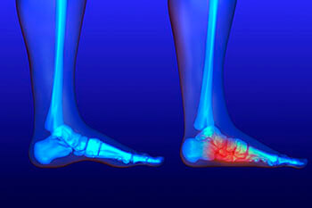 flat feet treatment in the Berks County, PA: Reading (Muhlenberg, Cumru, Wyomissing, Blandon, Shillington, Pennside, Birdsboro, West Reading, Sinking Spring, Laureldale, Reiffton, Fleetwood) areas