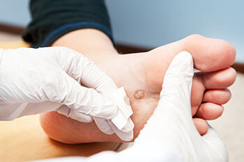 foot warts treatment in the Berks County, PA: Reading (Muhlenberg, Cumru, Wyomissing, Blandon, Shillington, Pennside, Birdsboro, West Reading, Sinking Spring, Laureldale, Reiffton, Fleetwood) areas